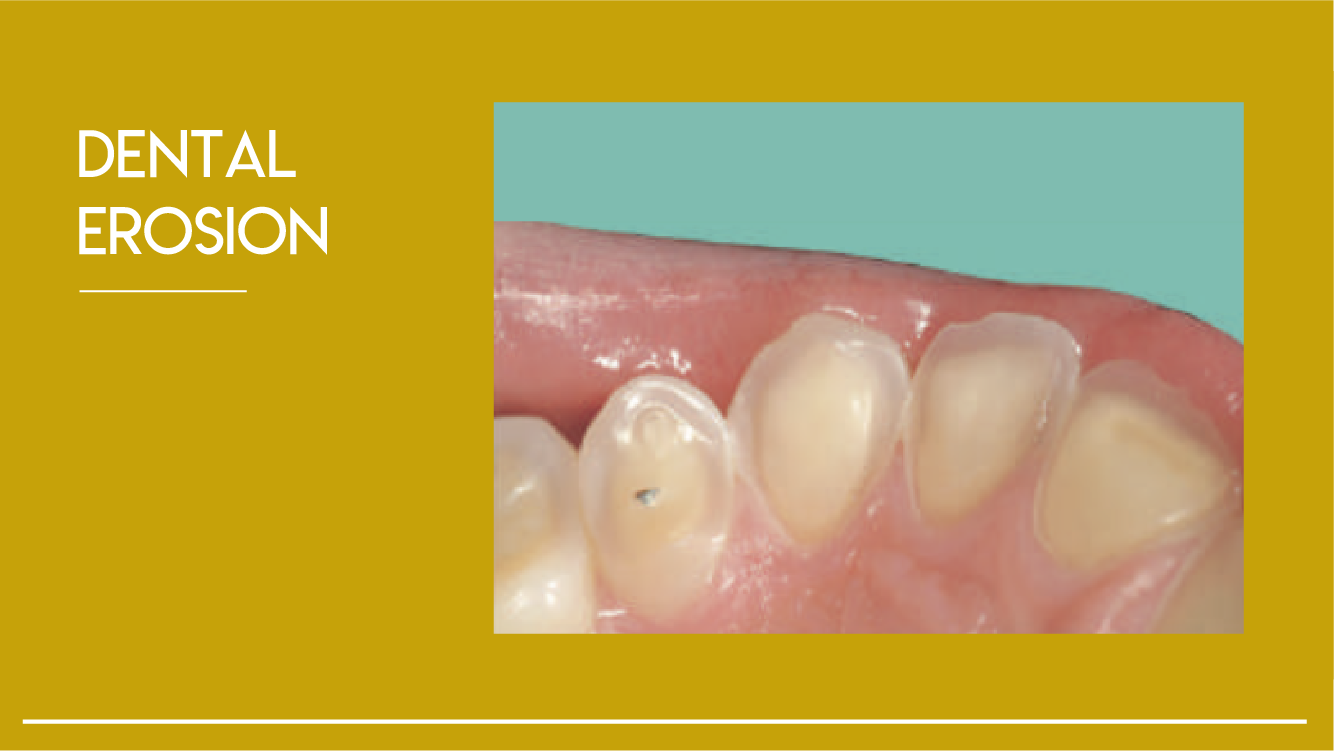 02 | Dental Erosion