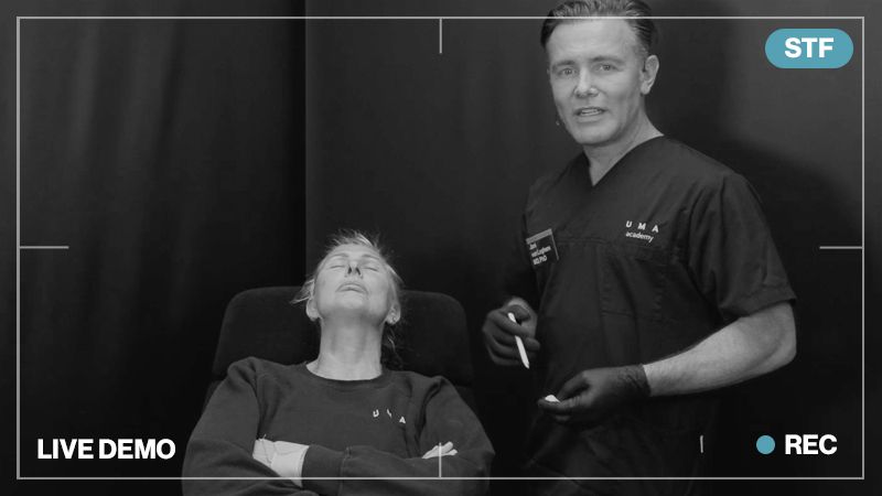 middle third | palpebromalar groove & pyriform area