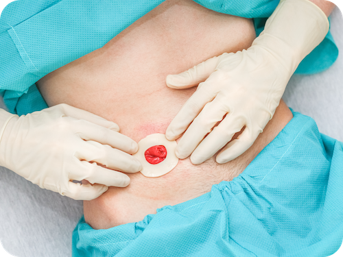 Stomaöffnung am Bauch