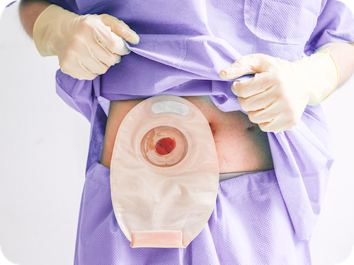 Stoma am Bauch