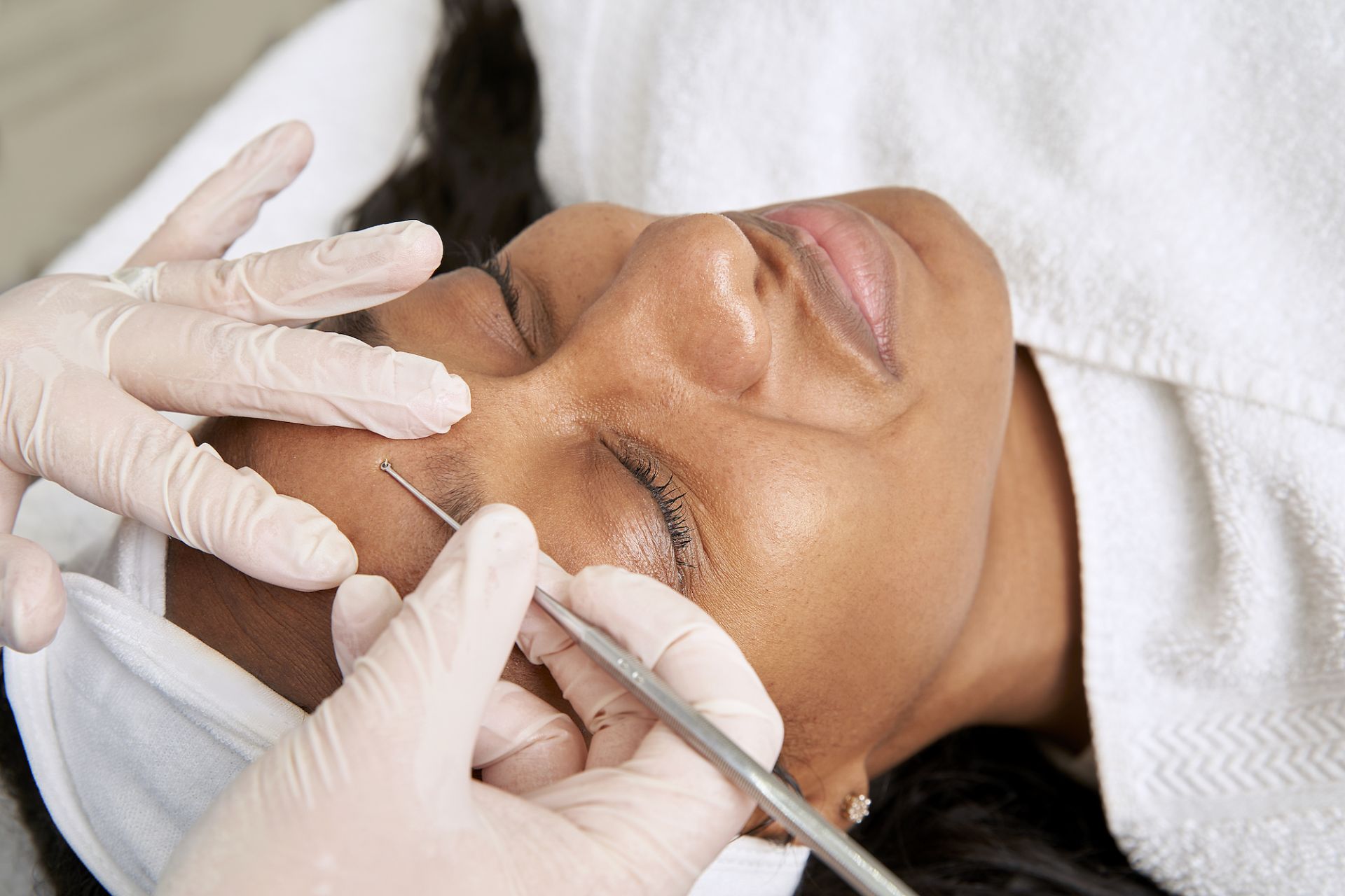 Acne - Diagnosis and treatment - Mayo Clinic