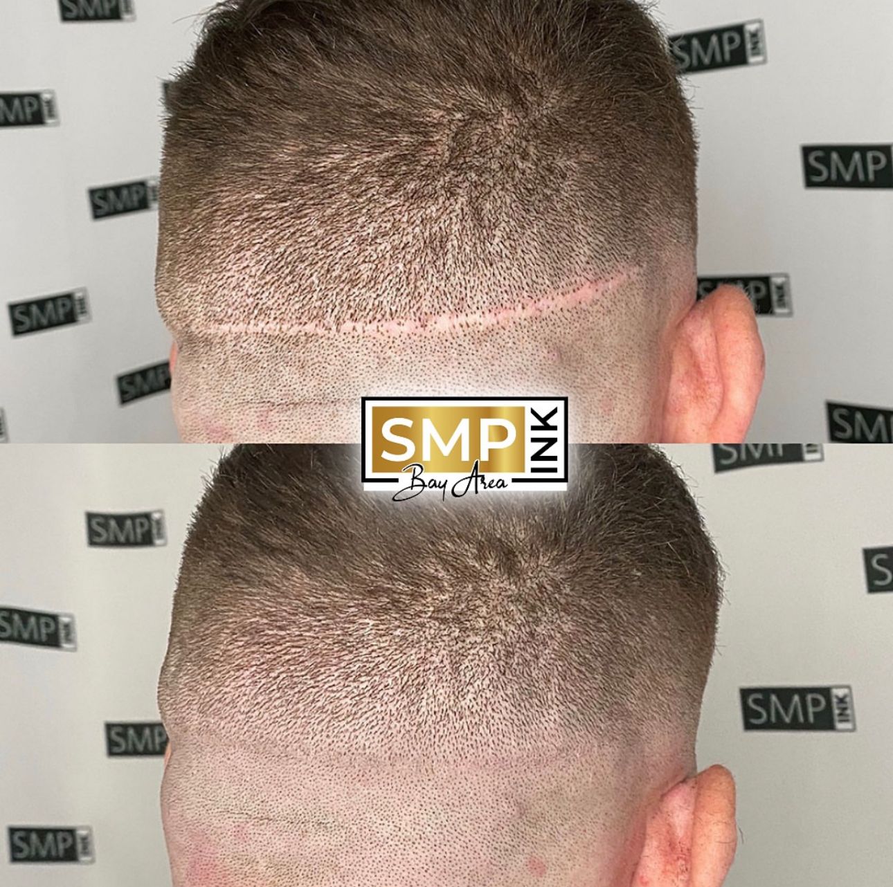 Scar camouflage tattoo before and after results paramedical specialist Bay Area