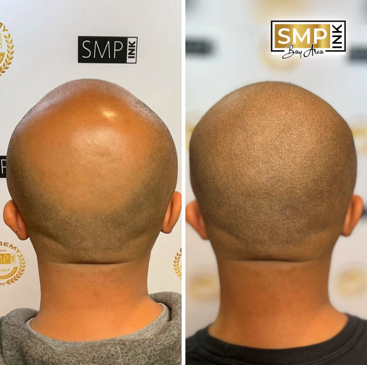 Scalp micropigmentation before and after results SMP Ink SF Bay Area