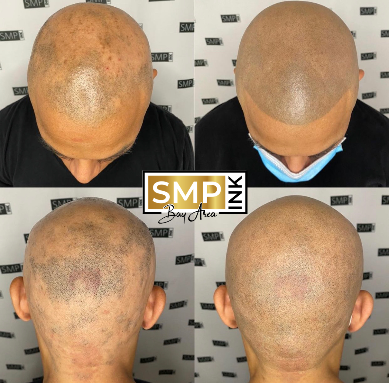 Scalp micropigmentation on shaved head client SMP Ink Danville CA