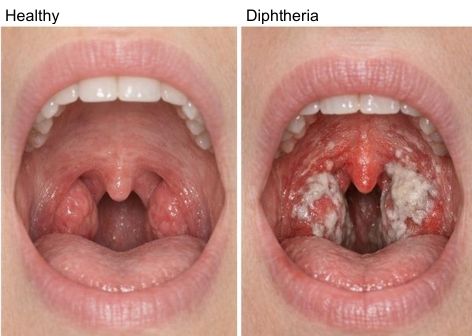 diphtheria-symptoms-aged-care-residents
