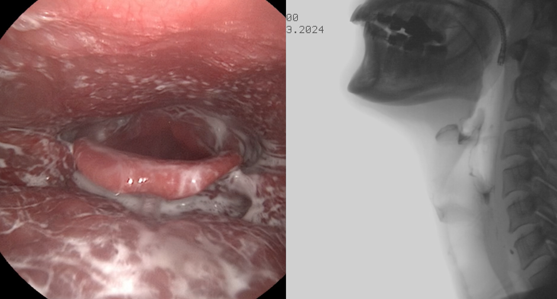 Flexible endoscopic swallow evaluation FEES modified barium swallow study MBS