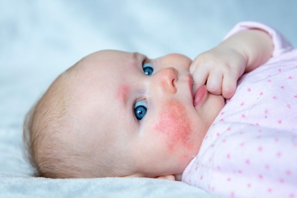 Online Master's degree in Pediatric Allergy