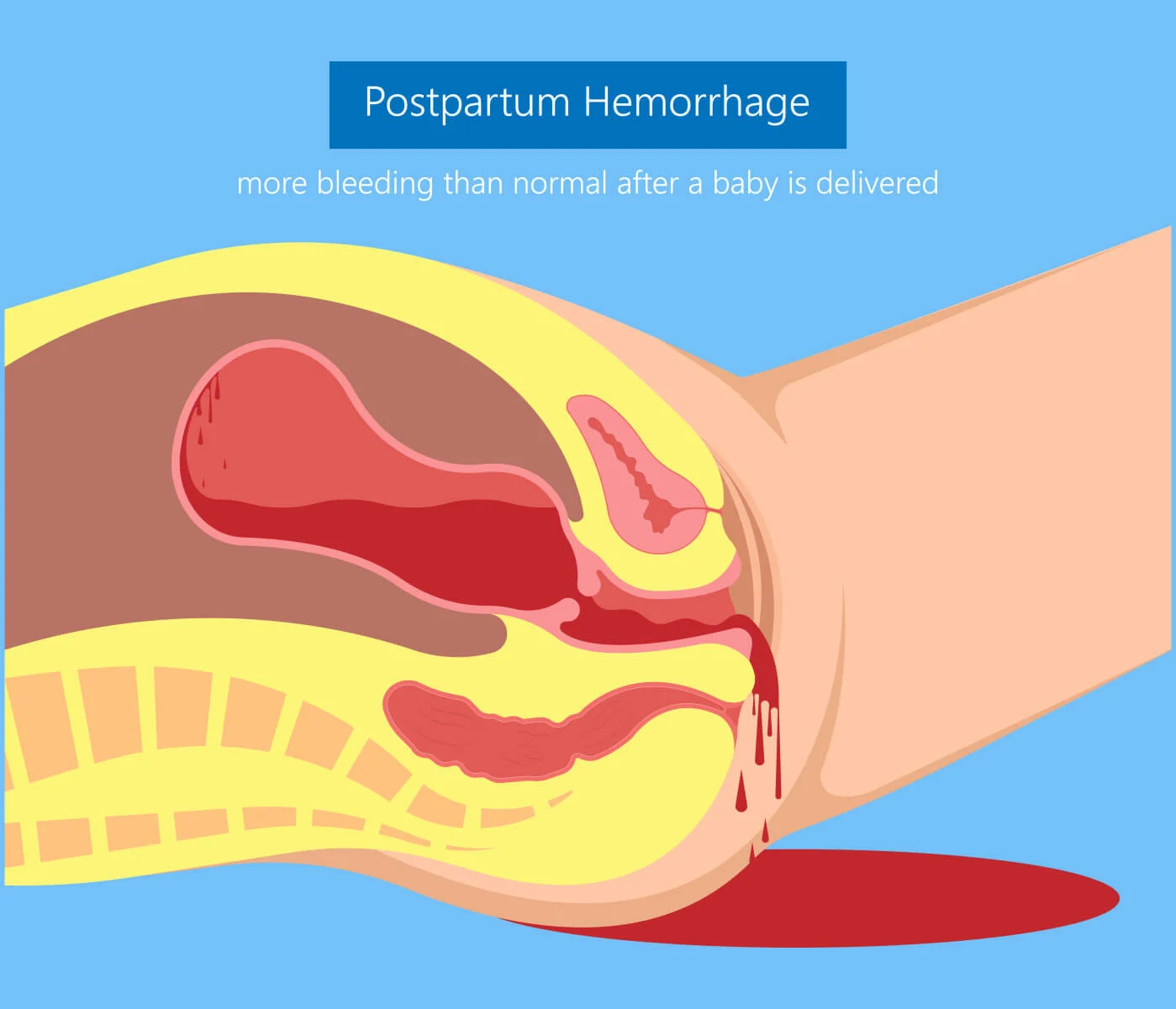 Postpartum hemorrhage after childbirth