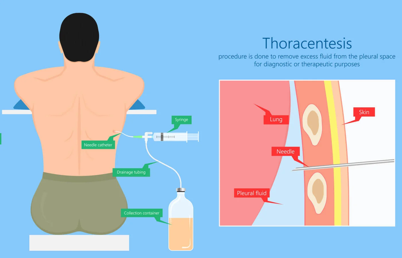 Thoracentesis procedure for pleural effusion
