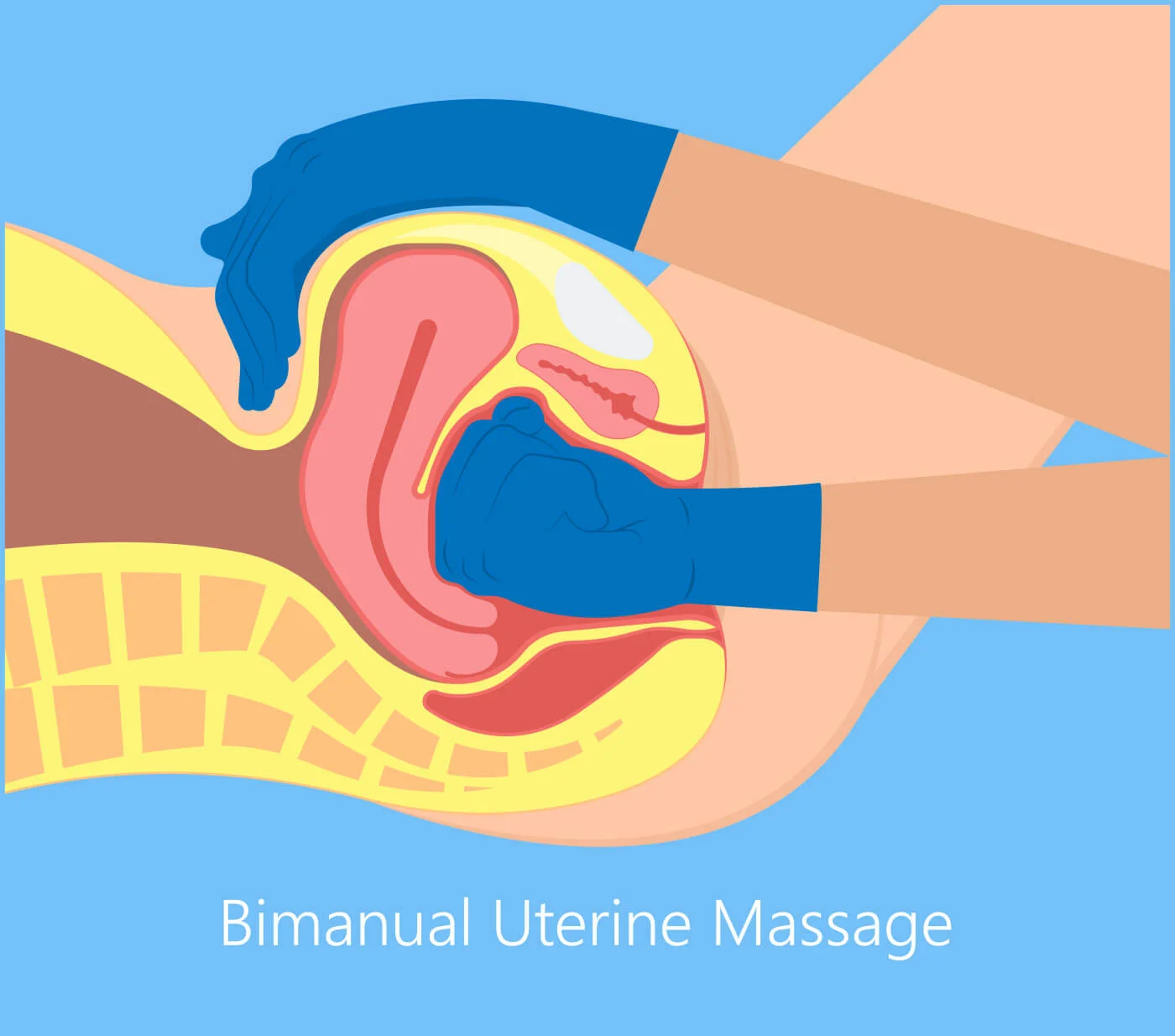 Bimanual uterine massage for postpartum hemorrhage