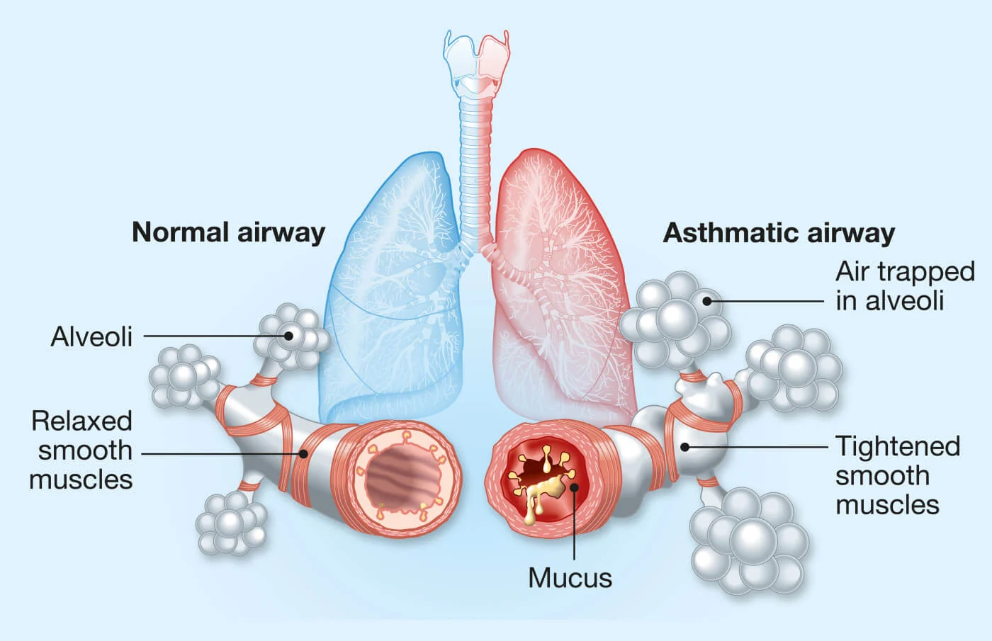 Asthma airway narrowing and mucus buildup