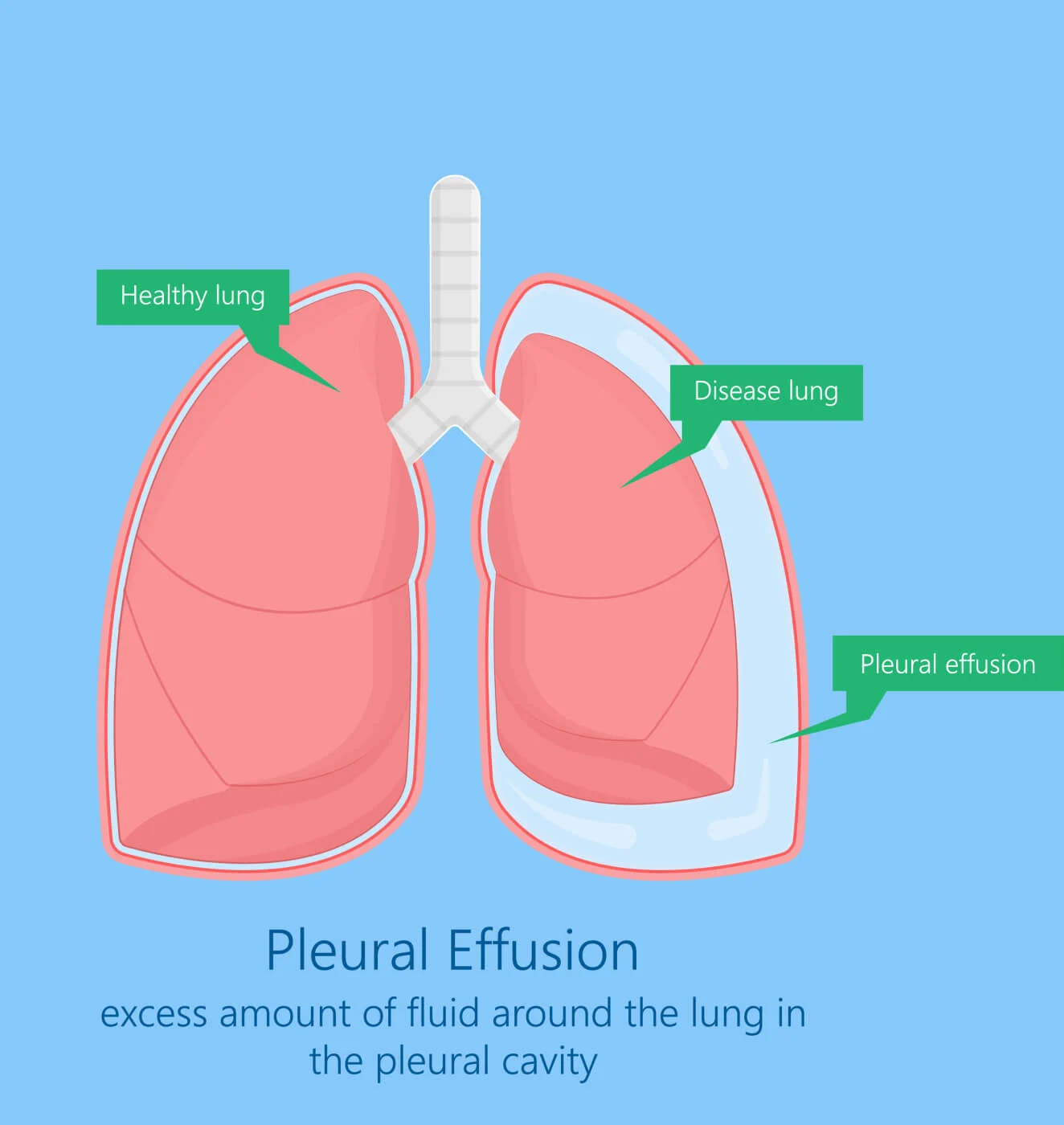 User attachment Pleural effusion showing excess fluid around the lung