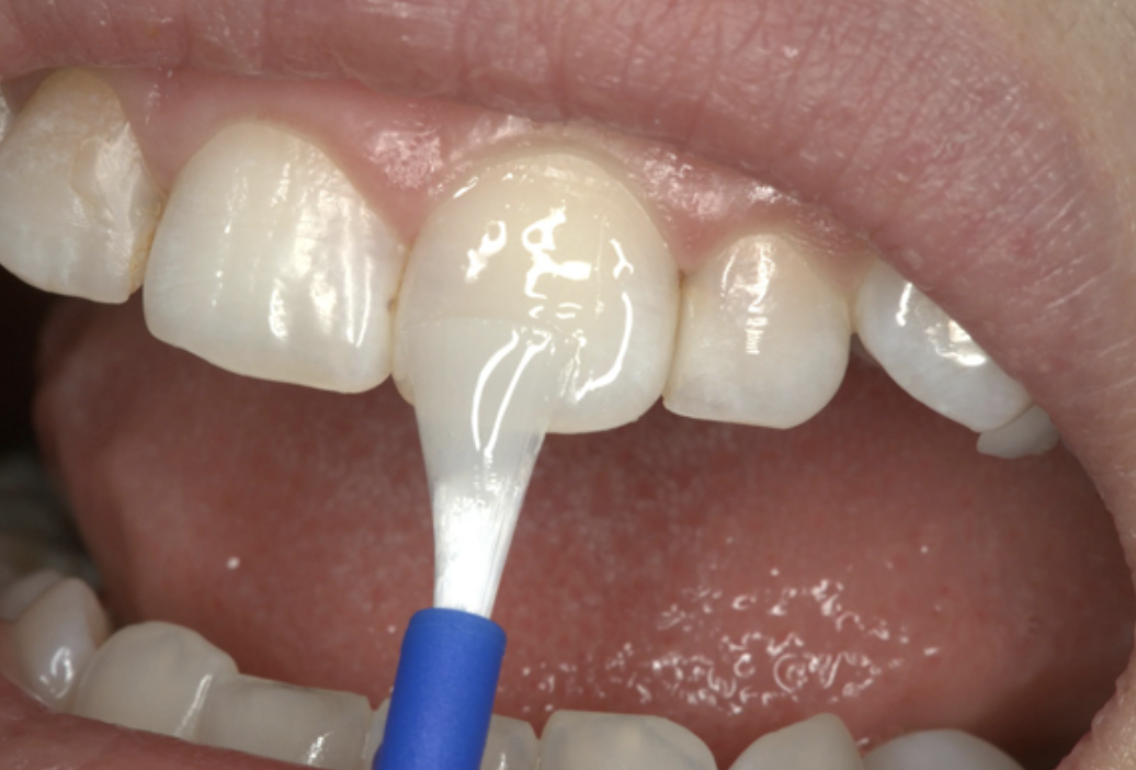 https://www.austinparkdental.com/procedures/pediatric-dentistry/fluoride/