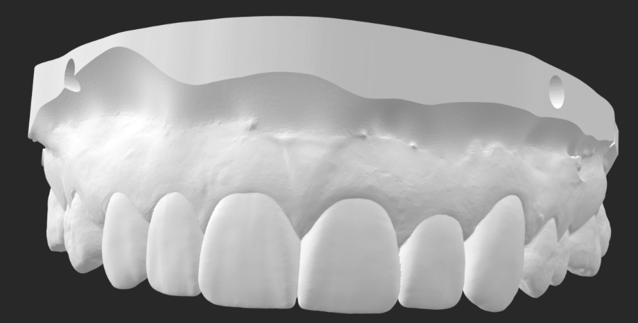 3D printed provisional restorations on a printed model