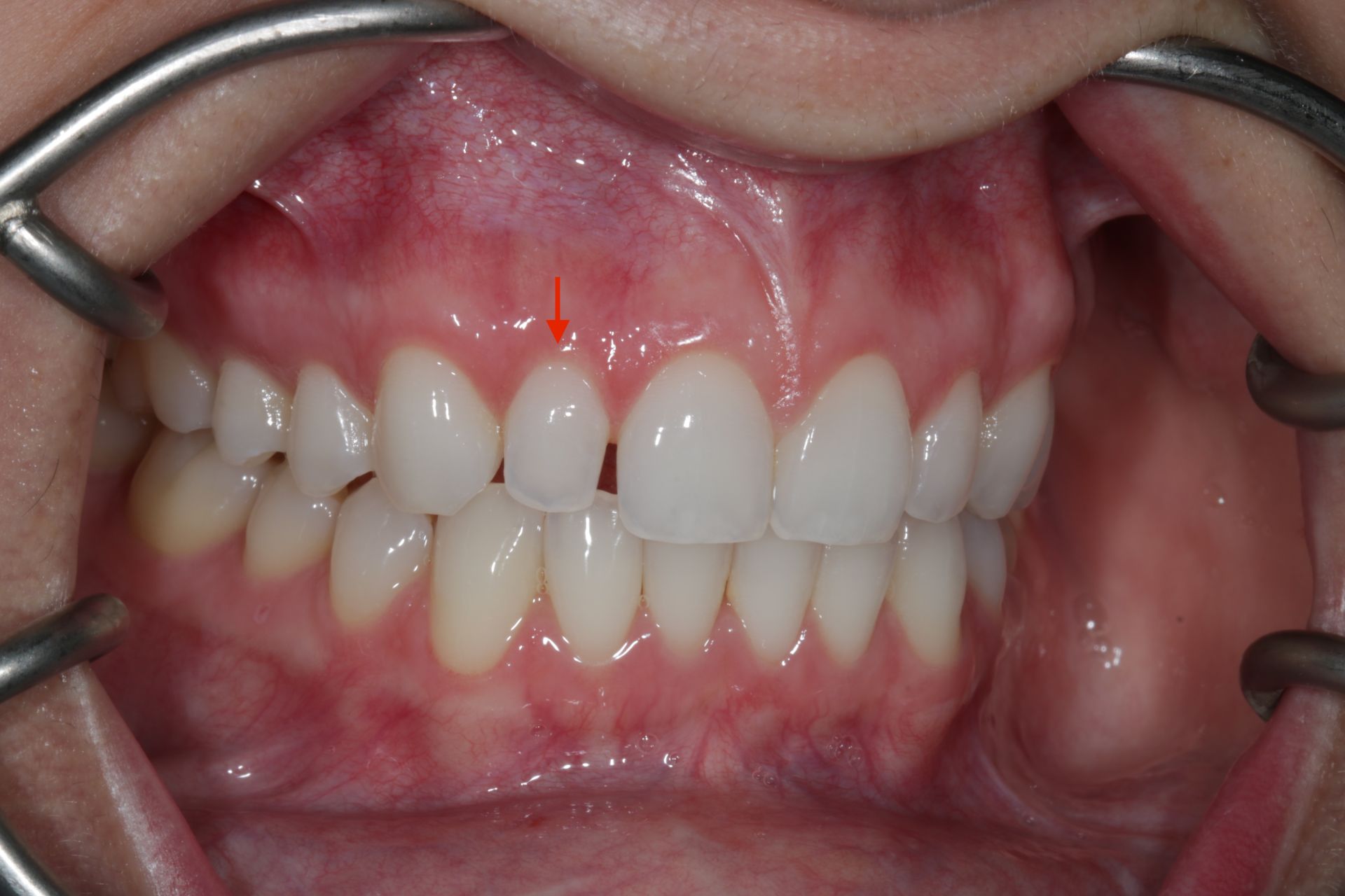 Retracted anterior view of Dr. Nick's own veneer case, annotated at the incisal edge