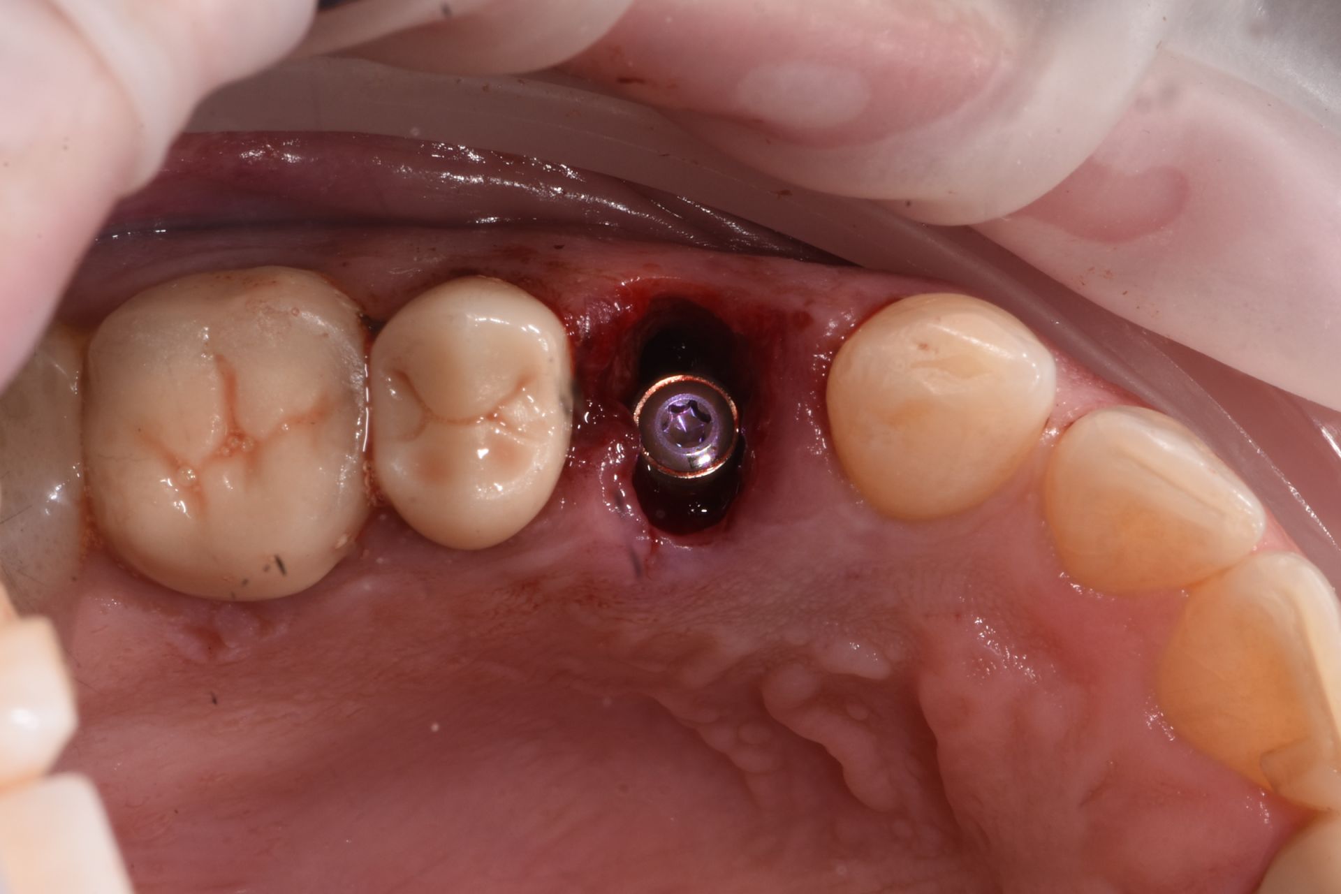 Immediate implant placed in a molar socket, occlusal view