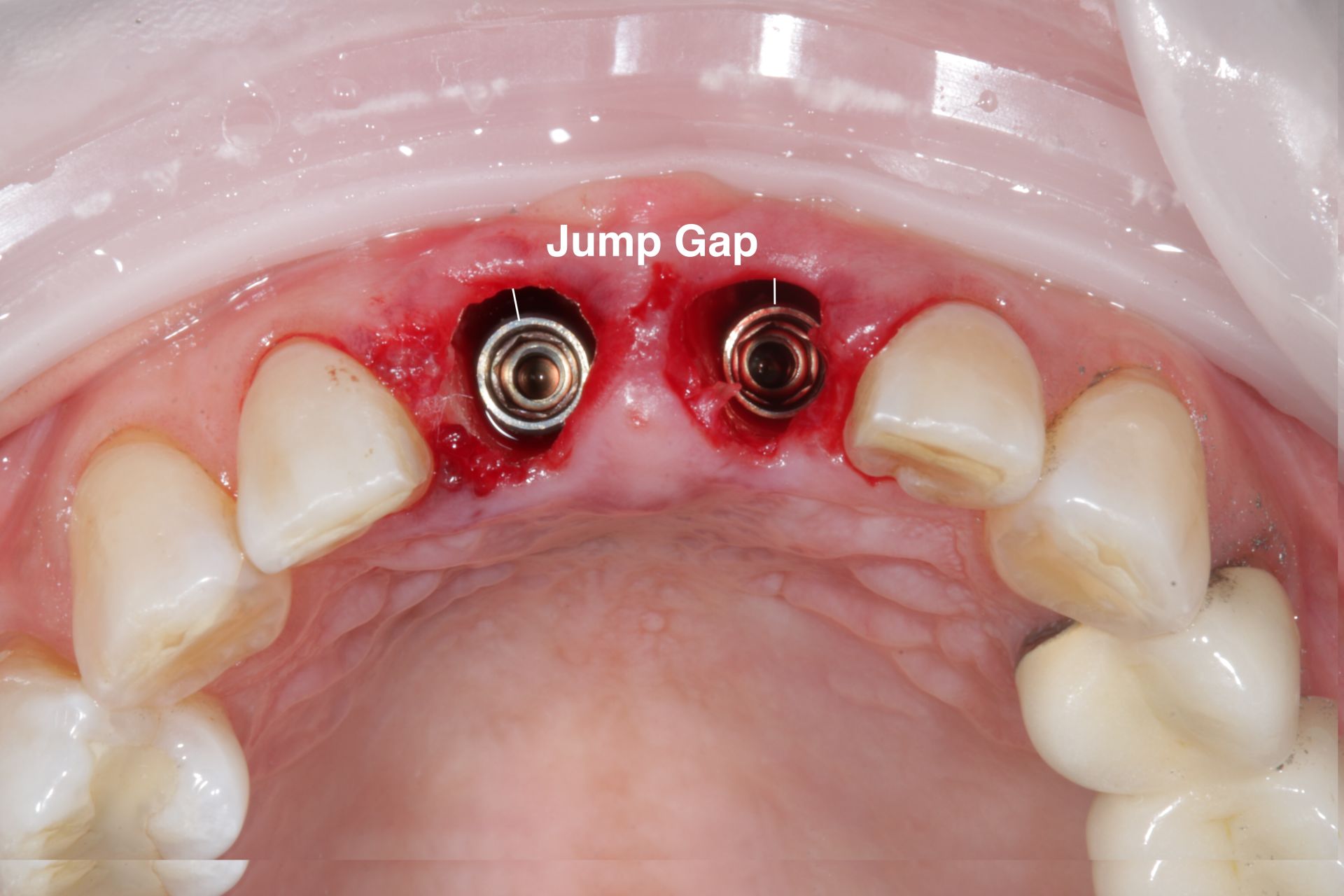 Two anterior immediate implants showing the labeled jump gap