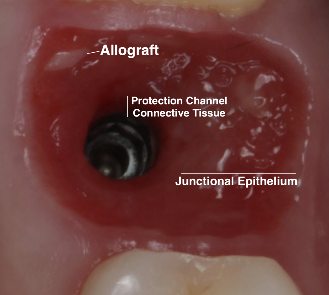 Diagram labeling allograft, protection channel, connective tissue and junctional epithelium