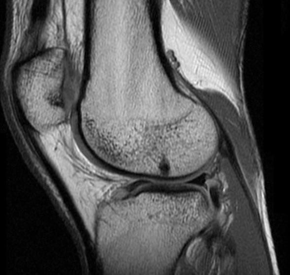 MRI image of a knee, side view.