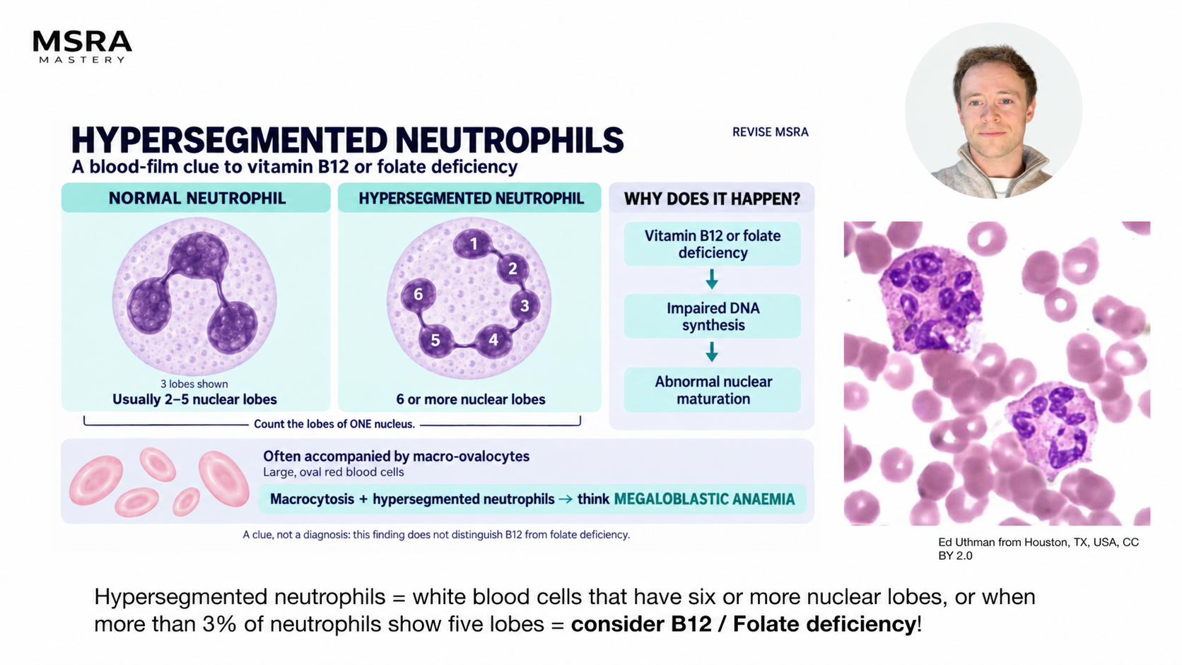 MSRA Mastery Haematology: Hypersegmented neutrophils; course preview with Dr Sam Gordon’s presenter portrait