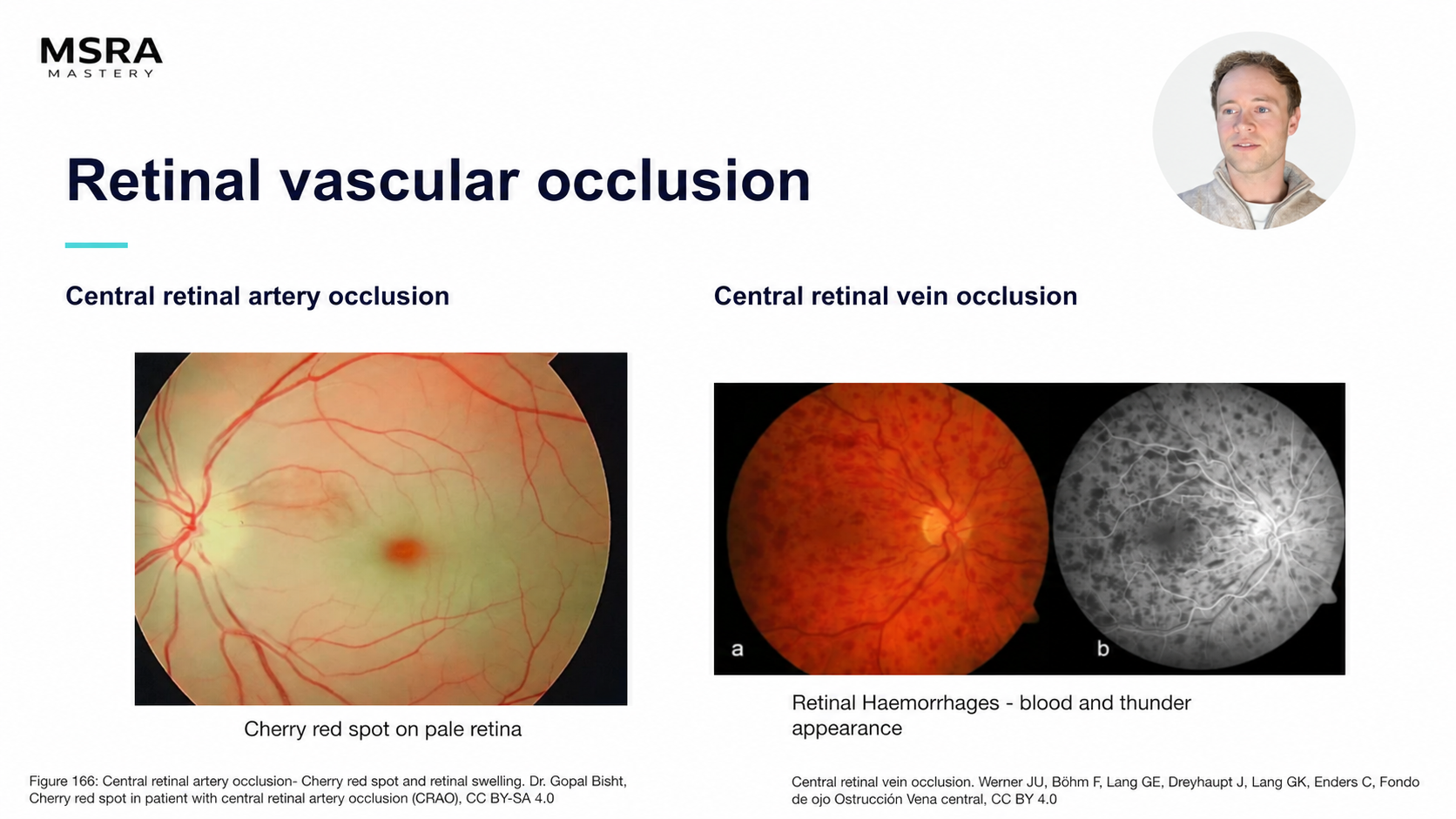 MSRA Mastery Ophthalmology: Retinal vascular occlusion; course preview with Dr Sam Gordon’s presenter portrait