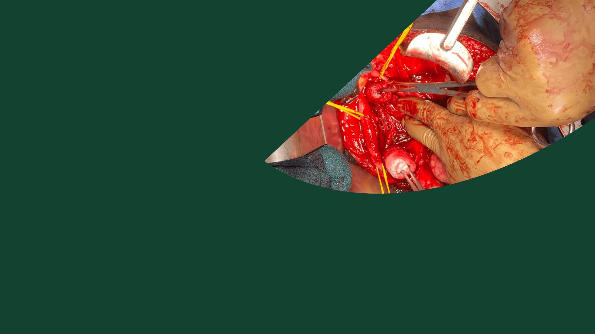 suturing-vertical-mattress-free-online-course