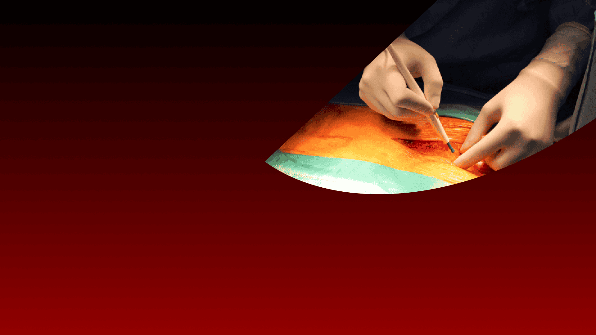 acute-mesenteric-ischemia-behind-the-knife-general-surgery-oral-board