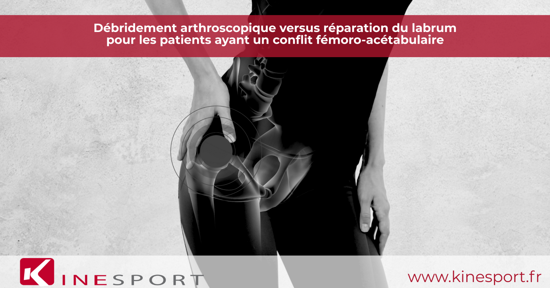Débridement arthroscopique versus réparation du labrum pour les patients ayant un conflit fémoro