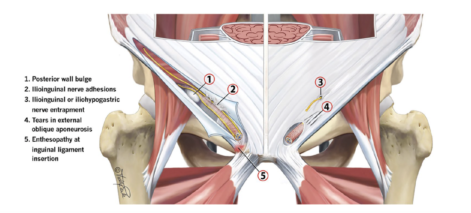 Ce schéma illustre les différentes causes potentielles de douleur inguinale d’origine neuropathique et musculo-tendineuse, fréquemment rencontrées chez les athlètes. Il met en évidence plusieurs structures anatomiques pouvant être impliquées dans cette pathologie complexe.