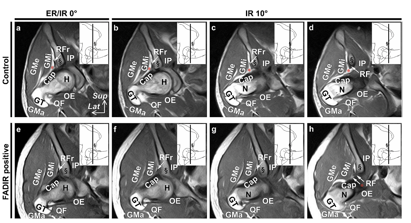 Les images montrent des coupes coronales prises en rotation neutre (ER/IR 0°, image a) et en rotation interne de 10° (IR 10°, images b-d) à 90° de flexion de hanche