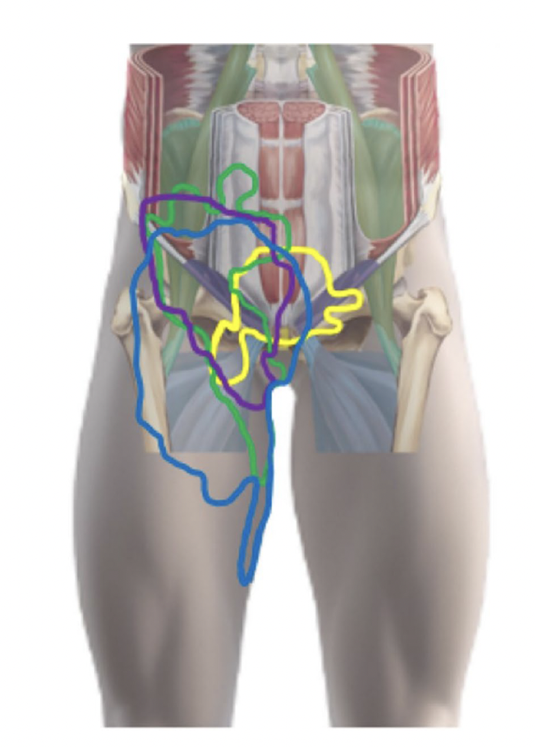 Ce schéma illustre les différentes zones de douleur inguinale rapportées par des patients dans une étude. Les lignes colorées représentent les variations dans la perception de la douleur, mettant en évidence la diversité des localisations et des irradiations possibles.
