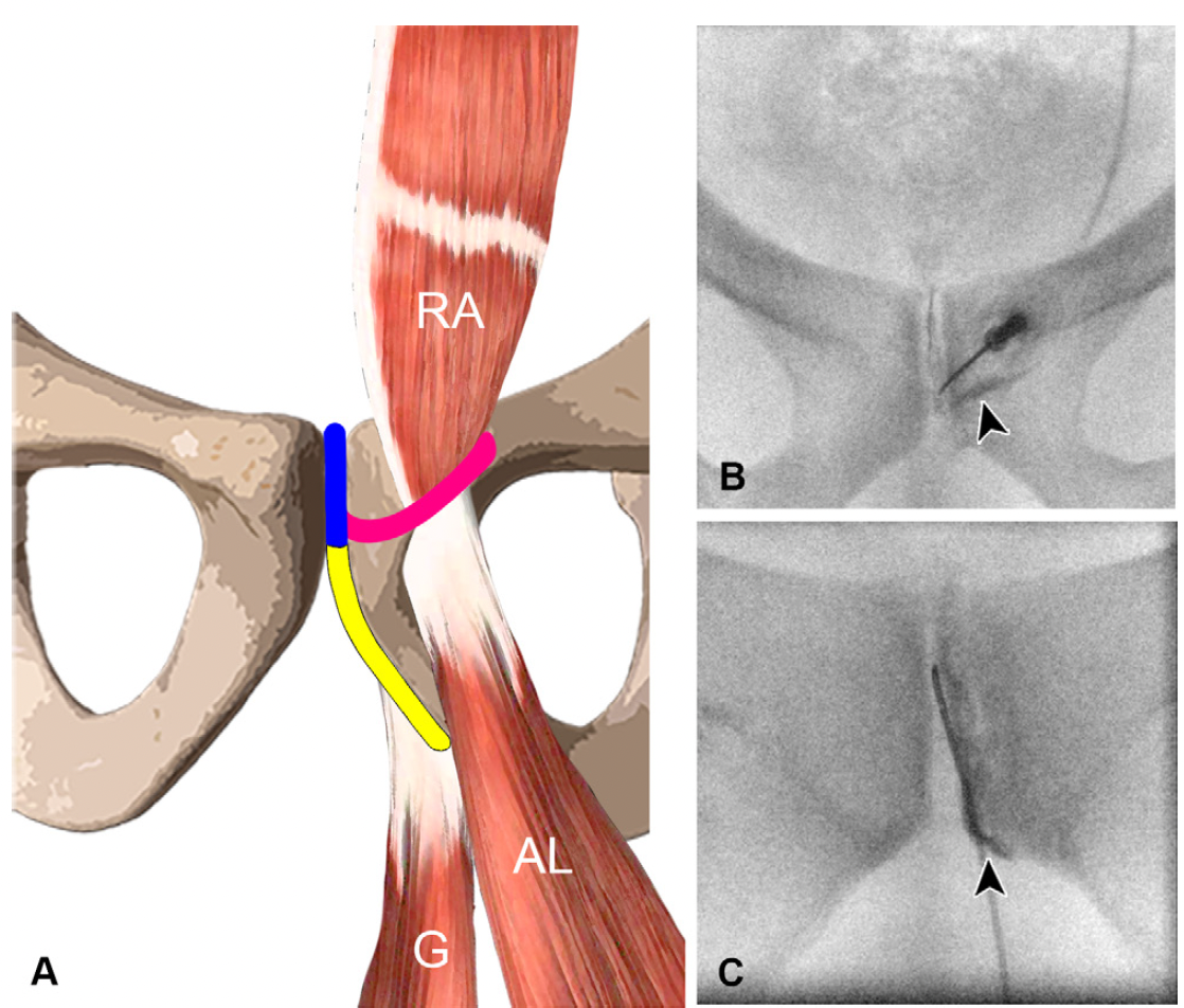 Schéma anatomique et fluoroscopie interventionnelle