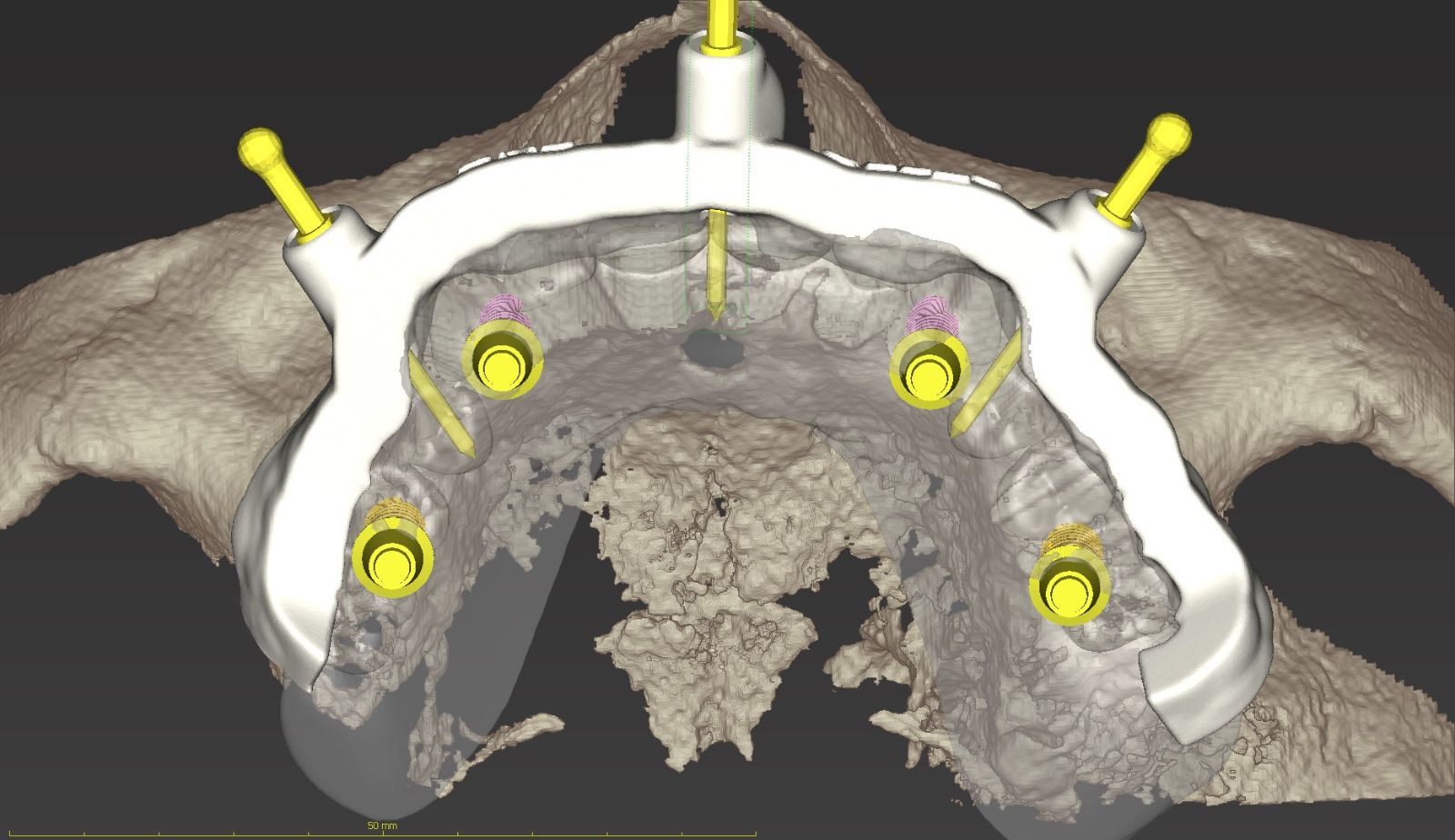 Guided Implant Surgery: is it something for me?