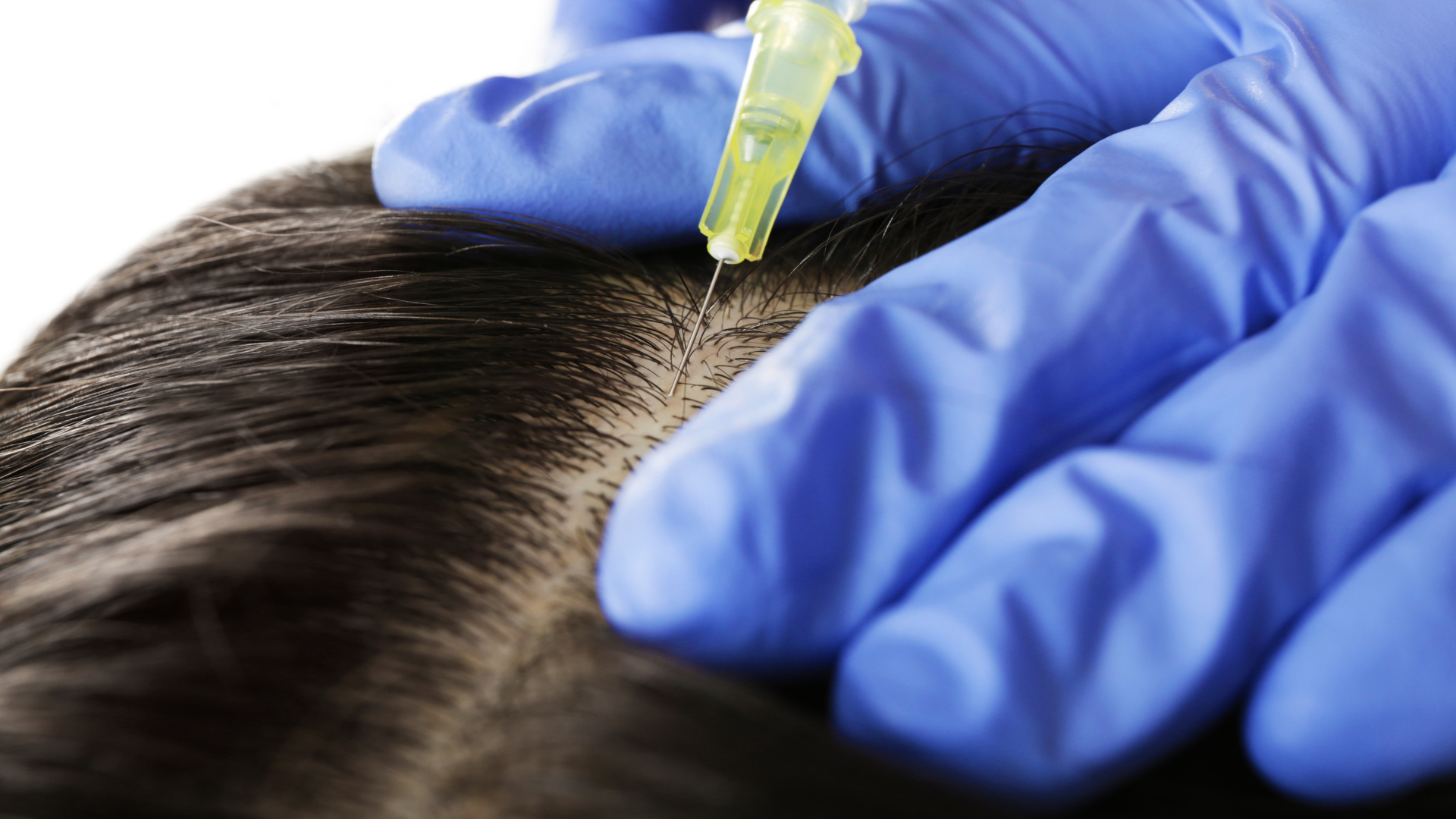 Hair Filler Injections