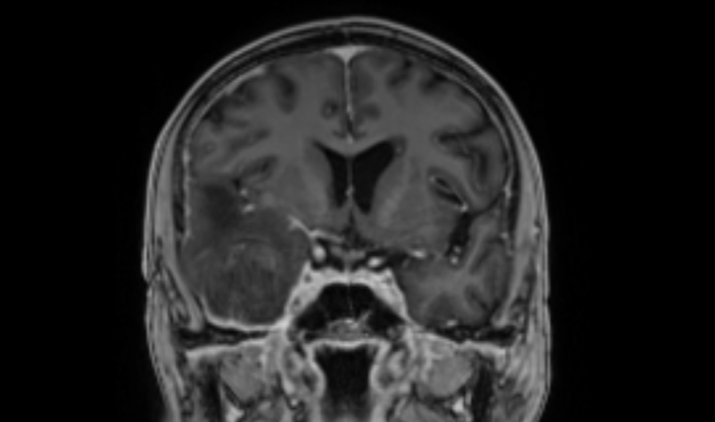 Ten Week Mri Foundations Week 10: MRI Brain