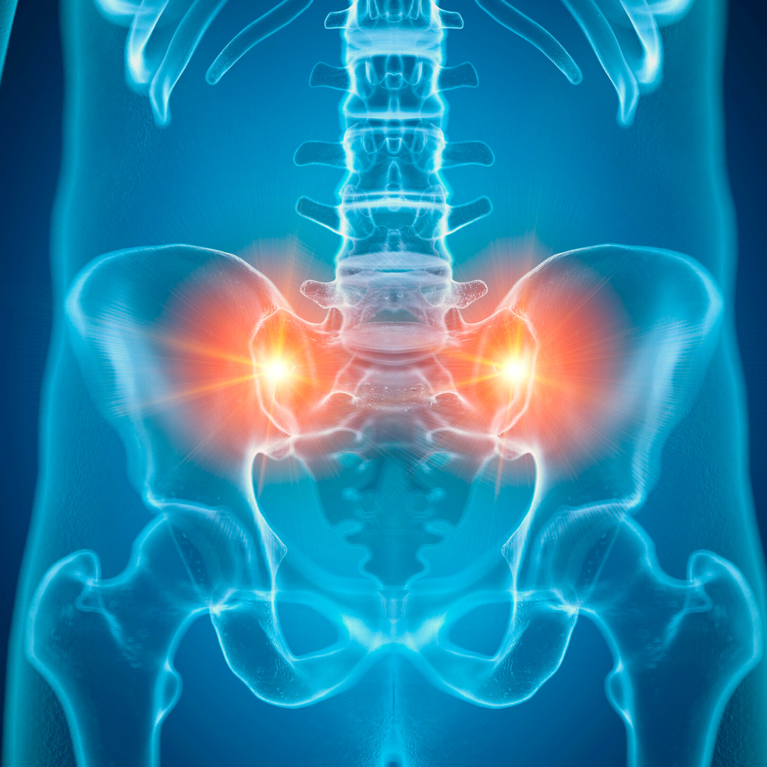 Image of an inflamed Sacroiliac (SI) Joint 